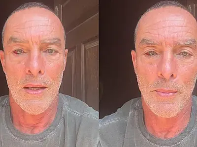 Derrame ocular como o do ator e modelo Paulo Zulu é perigoso?